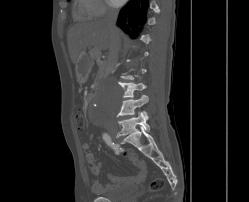 File:Chronic contained rupture of abdominal aortic aneurysm with extensive erosion of the vertebral bodies (Radiopaedia 55450-61901 Sagittal bone window 5).jpg