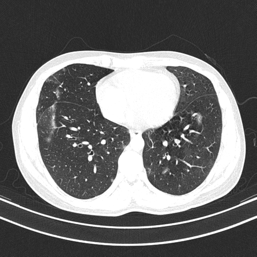 File:Chronic eosinophilic pneumonia (Radiopaedia 39331-41587 Axial lung window 36).png