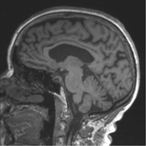Chronic hypertensive encephalopathy (Radiopaedia 39993-42482 Sagittal T1 52).png