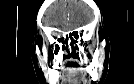 Chronic invasive fungal sinusitis (Radiopaedia 91563-109286 D 60).jpg
