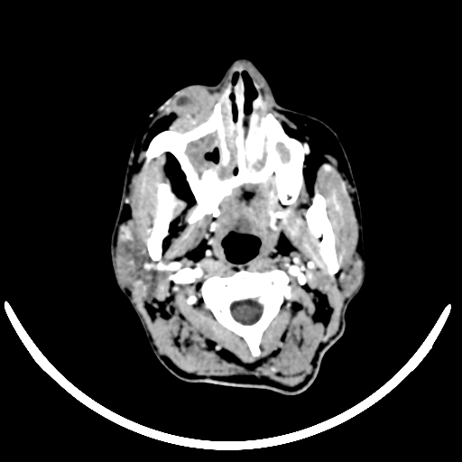 Chronic invasive fungal sinusitis with intraorbital and intracranial extension (Radiopaedia 56387-63046 B 17).jpg