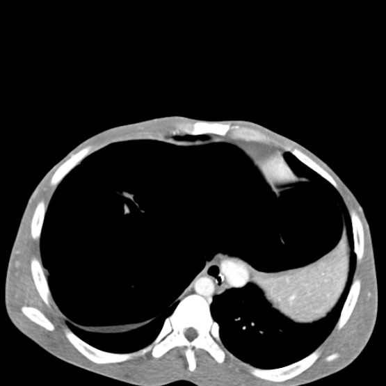File:Chronic large bowel pseudo-obstruction (Radiopaedia 43181-46492 A 33).jpg