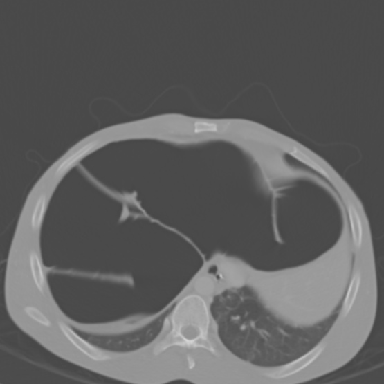 Chronic large bowel pseudo-obstruction (Radiopaedia 43181-46492 Axial bone window 34).jpg
