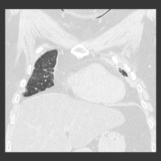 Chronic lung allograft dysfunction - restrictive form (Radiopaedia 60595-68316 Coronal lung window 34).jpg