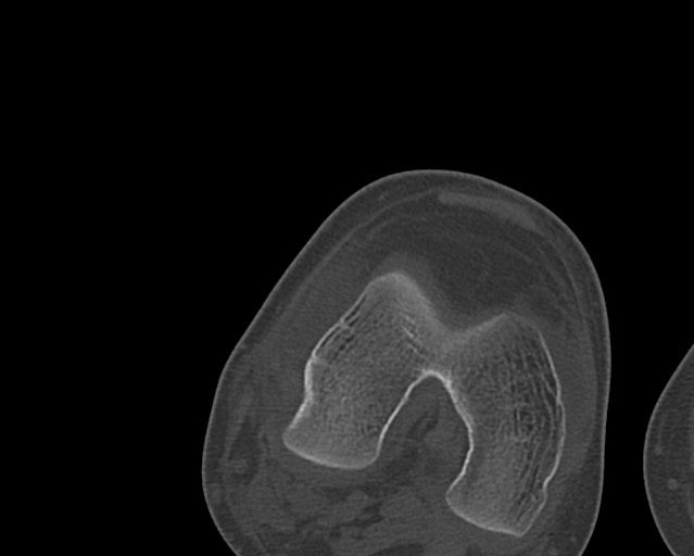 Chronic ostemyelitis of the femur with long sinus tract (Radiopaedia 74947-85982 Axial bone window 223).jpg