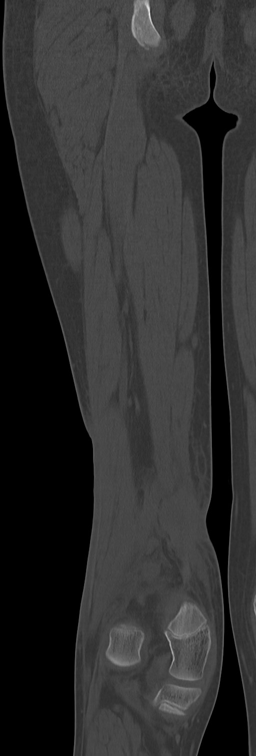 Chronic ostemyelitis of the femur with long sinus tract (Radiopaedia 74947-85982 Coronal bone window 57).jpg
