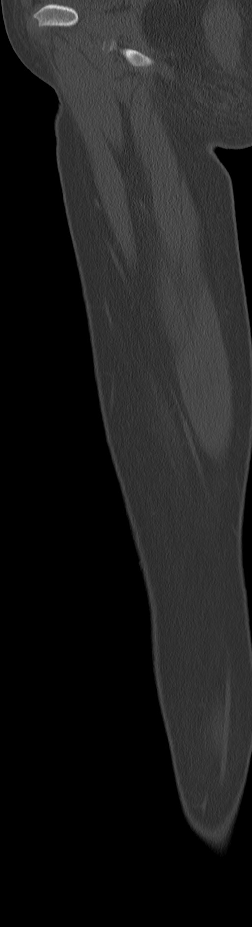 Chronic ostemyelitis of the femur with long sinus tract (Radiopaedia 74947-85982 Sagittal bone window 83).jpg