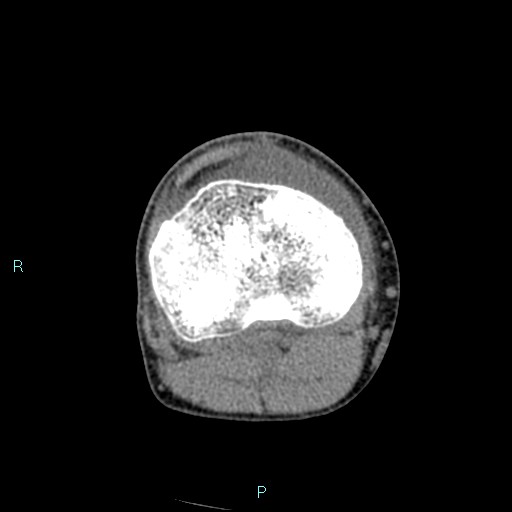 File:Chronic osteomyelitis (with Brodie abscess) (Radiopaedia 76405-88111 A 99).jpg