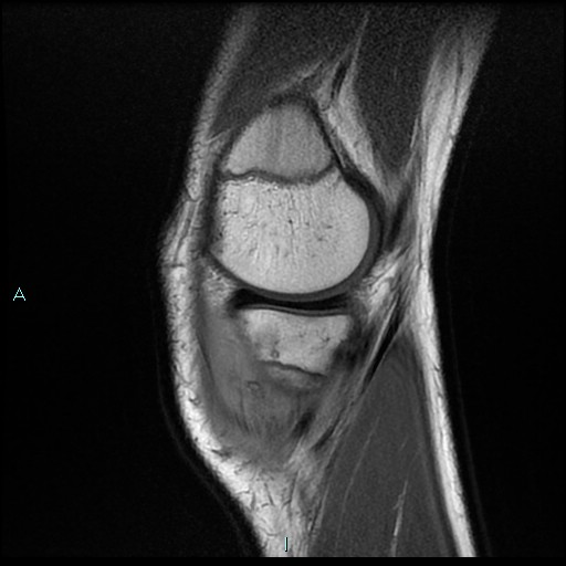 File:Chronic osteomyelitis (with Brodie abscess) (Radiopaedia 76405-88112 Sagittal PD 5).jpg