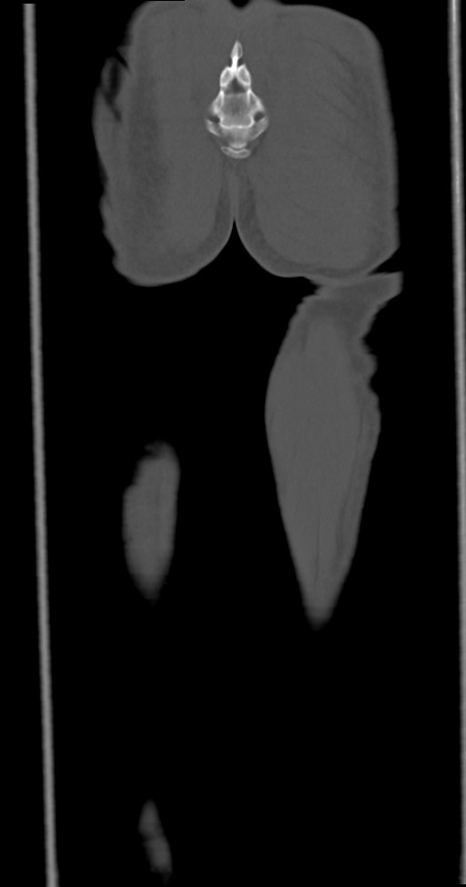Chronic osteomyelitis (with sequestrum) (Radiopaedia 74813-85822 Coronal non-contrast 54).jpg