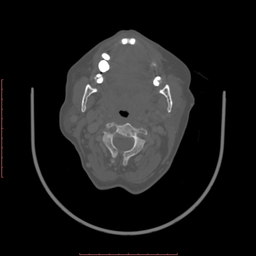 Chronic osteomyelitis - maxilla (Radiopaedia 23783-23927 Axial bone window 58).jpg