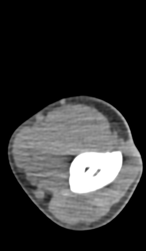 Chronic osteomyelitis of the distal humerus (Radiopaedia 78351-90971 Axial non-contrast 72).jpg