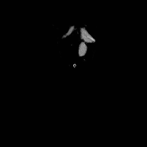 Chronic portal venous thrombosis with cavernous transformation (Radiopaedia 73618-84398 B 36).jpg
