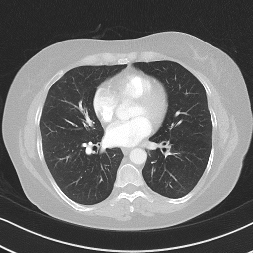 Chronic pulmonary embolus (Radiopaedia 39129-41341 Axial lung window 37).png