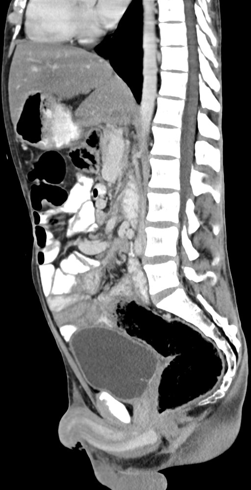 Chronic small bowel volvulus (Radiopaedia 75224-86322 C 76).jpg