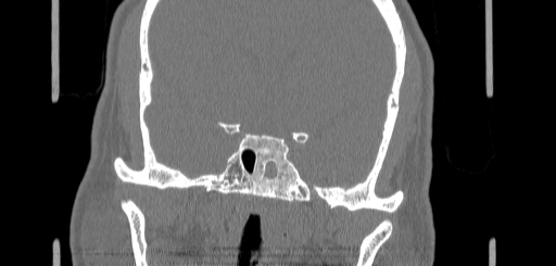 Chronic sphenoidal sinusitis (Radiopaedia 62030-70122 Coronal bone window 129).jpg