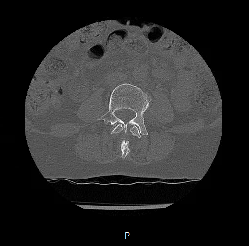 Chronic spinal hematoma with cauda equina syndrome (Radiopaedia 75745-88197 Axial bone window 20).png