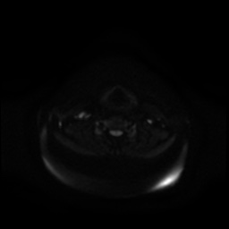 Chronic submandibular sialadenitis (Radiopaedia 61852-69885 Axial DWI 20).jpg