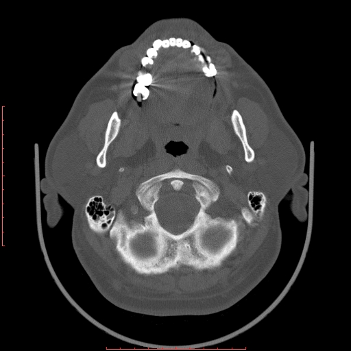 File:Chronic submandibular sialolithiasis (Radiopaedia 69817-79814 Axial bone window 19).jpg