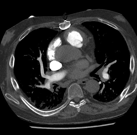 Chronic thromboembolic pulmonary disease (Radiopaedia 90694-108119 Axial C+ CTPA 52).jpg