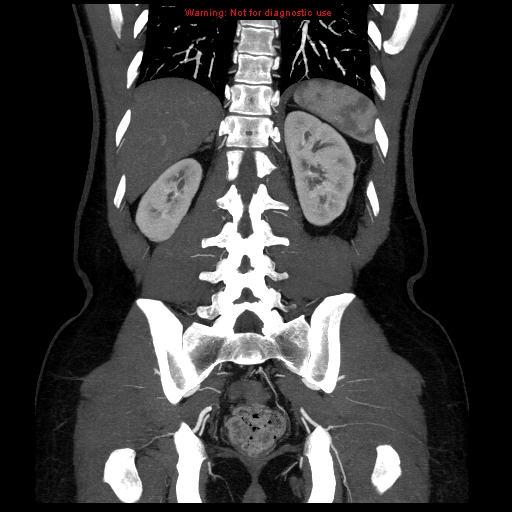 File:Circumaortic left renal vein (Radiopaedia 9069-9792 B 33).jpg