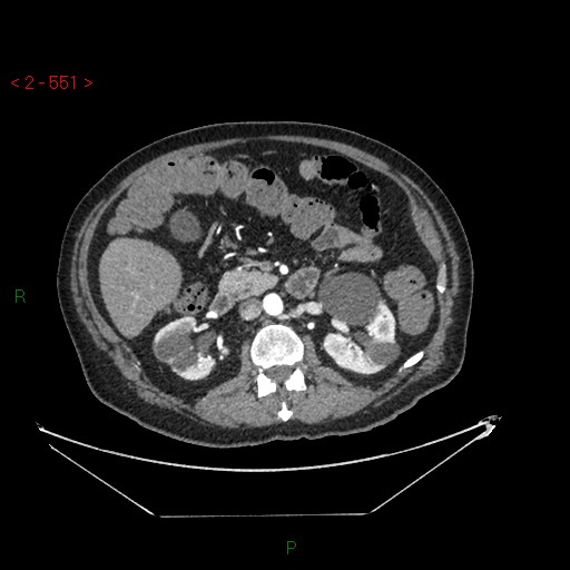 File:Circumaortic left renal vein and doubled left renal arteries (Radiopaedia 52268-58158 A 87).jpg