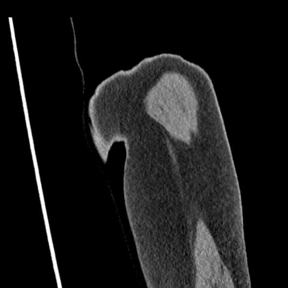 Clear cell chondrosarcoma - humerus (Radiopaedia 63104-71612 Coronal non-contrast 4).jpg