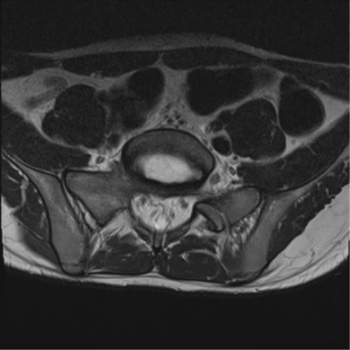 File:Clear cell meningoma - lumbar spine (Radiopaedia 60116-67690 Axial T2 5).png