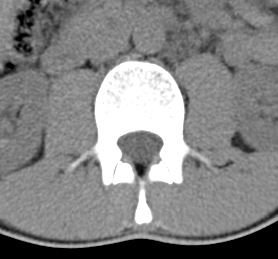 File:Clear cell meningoma - lumbar spine (Radiopaedia 60116-67691 Axial non-contrast 24).png