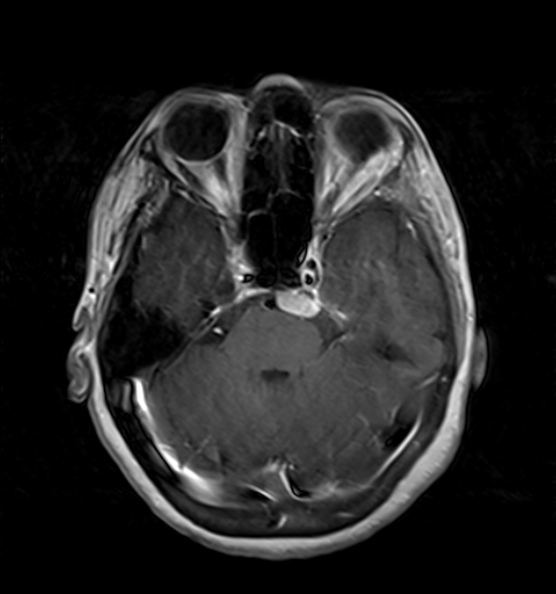 File:Clival meningioma (Radiopaedia 53278-59248 Axial T1 C+ 6).jpg