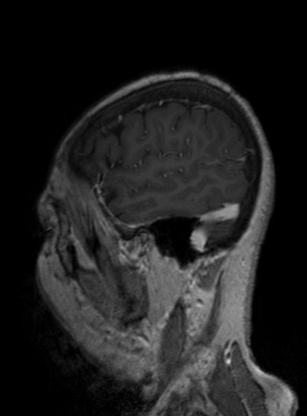 Clival meningioma (Radiopaedia 53278-59248 Sagittal T1 C+ 160).jpg