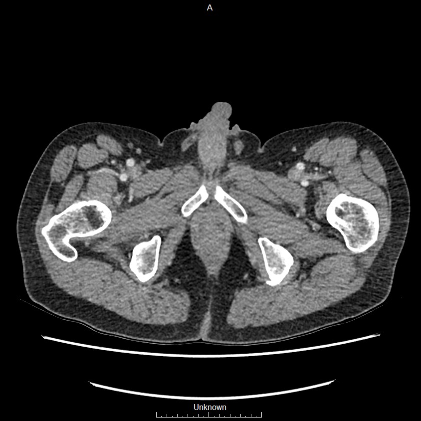 Closed loop bowel obstruction and ischemia (Radiopaedia 86959-103180 A 95).jpg