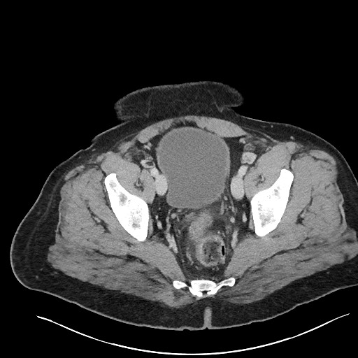 File:Closed loop obstruction - internal hernia into nephrectomy bed (Radiopaedia 59867-67320 A 126).jpg