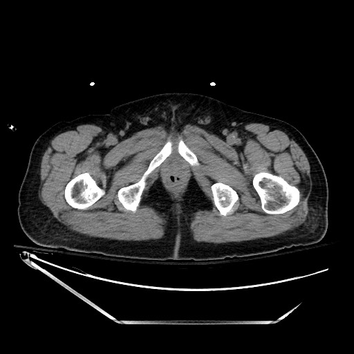 File:Closed loop obstruction due to adhesive band, resulting in small bowel ischemia and resection (Radiopaedia 83835-99023 Axial non-contrast 163).jpg