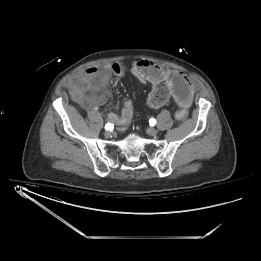 File:Closed loop obstruction due to adhesive band, resulting in small bowel ischemia and resection (Radiopaedia 83835-99023 B 113).jpg