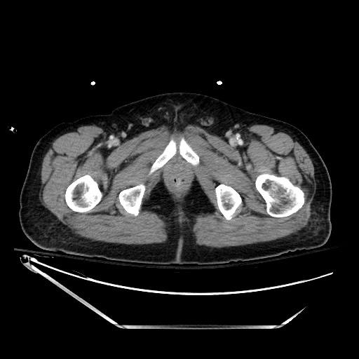 File:Closed loop obstruction due to adhesive band, resulting in small bowel ischemia and resection (Radiopaedia 83835-99023 D 162).jpg