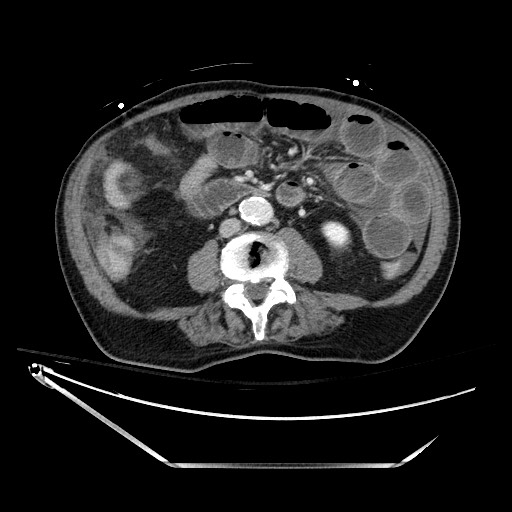 Closed loop obstruction due to adhesive band, resulting in small bowel ischemia and resection (Radiopaedia 83835-99023 D 83).jpg