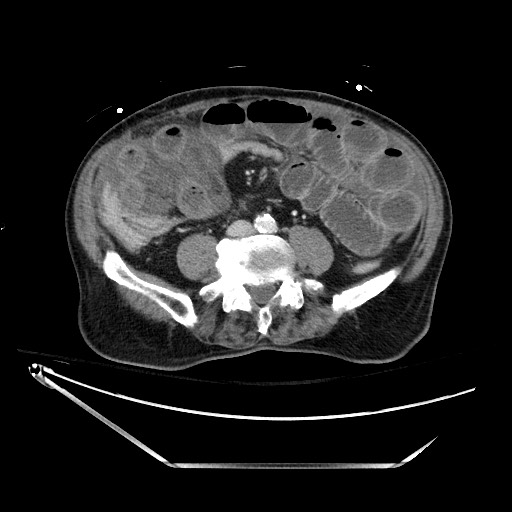 Closed loop obstruction due to adhesive band, resulting in small bowel ischemia and resection (Radiopaedia 83835-99023 D 95).jpg