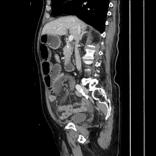 Closed loop obstruction due to adhesive band, resulting in small bowel ischemia and resection (Radiopaedia 83835-99023 F 82).jpg
