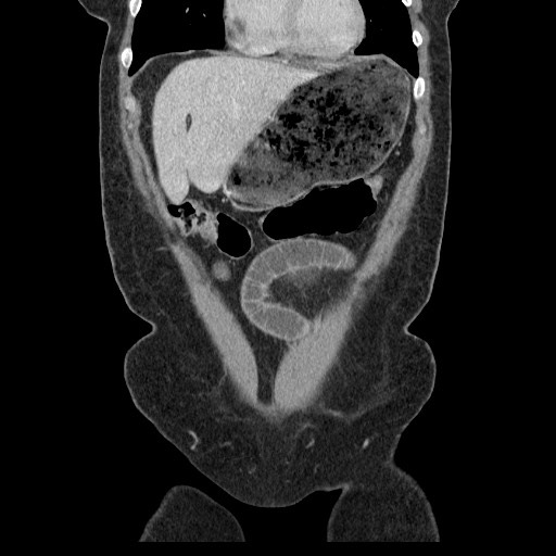 Closed loop small bowel obstruction (Radiopaedia 65403-74451 B 32).jpg