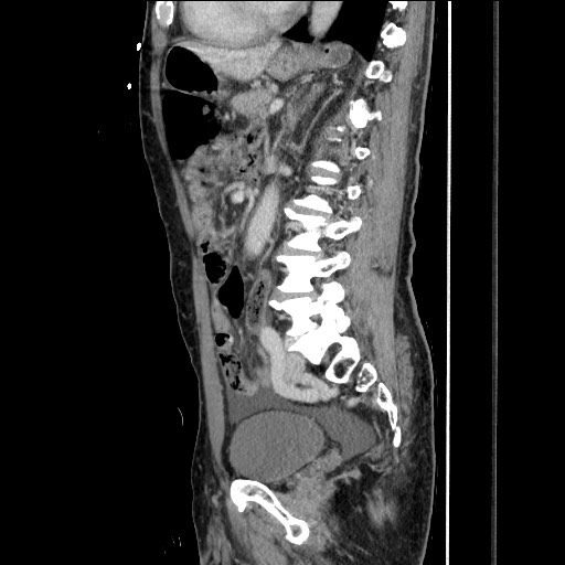 Closed loop small bowel obstruction - omental adhesion causing "internal hernia" (Radiopaedia 85129-100682 C 107).jpg