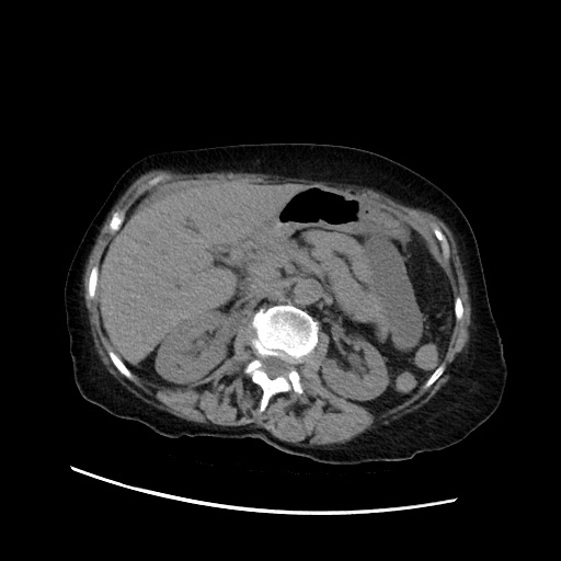 File:Closed loop small bowel obstruction due to adhesive band, with intramural hemorrhage and ischemia (Radiopaedia 83831-99017 Axial non-contrast 61).jpg