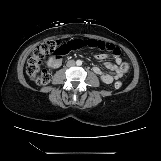 Closed loop small bowel obstruction due to adhesive bands - early and late images (Radiopaedia 83830-99014 A 78).jpg