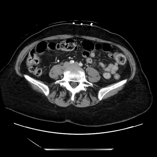 File:Closed loop small bowel obstruction due to adhesive bands - early and late images (Radiopaedia 83830-99014 A 93).jpg