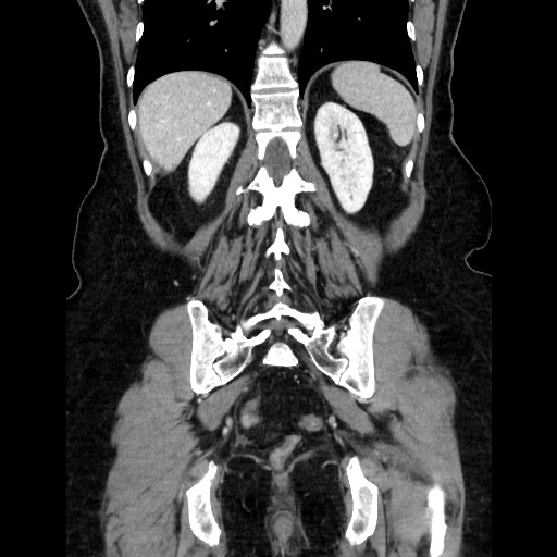 Closed loop small bowel obstruction due to adhesive bands - early and late images (Radiopaedia 83830-99015 B 92).jpg