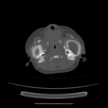 Cloverleaf skull (Radiopaedia 91901-109710 Axial bone window 39).jpg