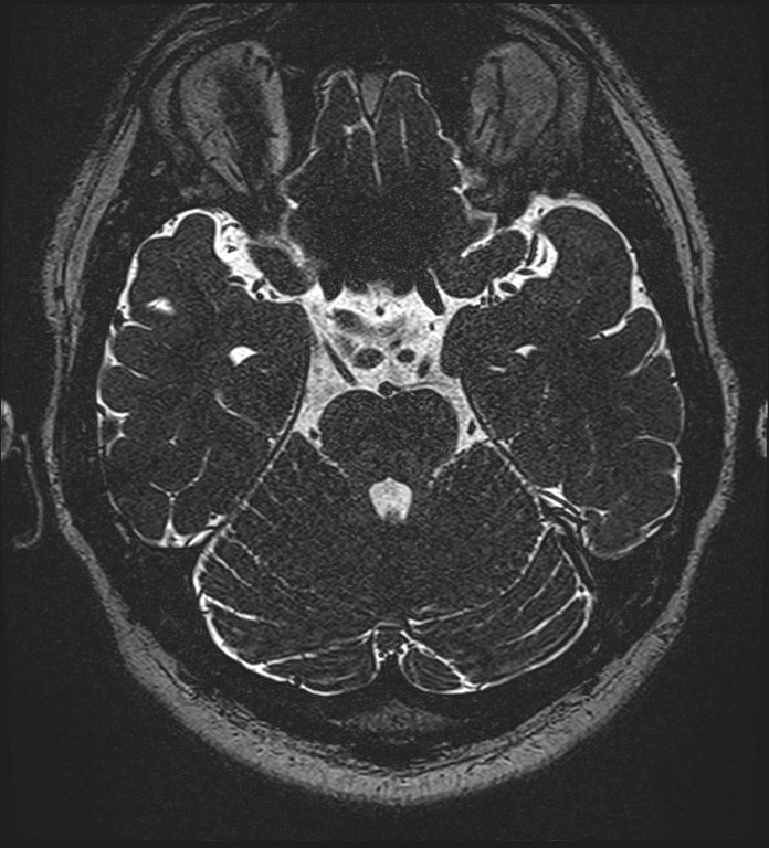 Cochlear incomplete partition type III associated with hypothalamic hamartoma (Radiopaedia 88756-105498 Axial T2 121).jpg