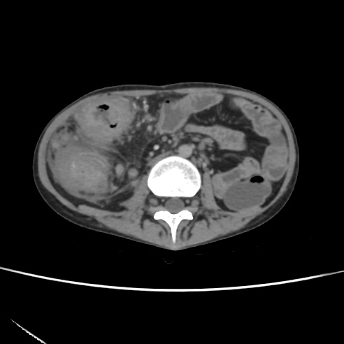 File:Colocolic fistula - Crohn disease (Radiopaedia 57063-63955 A 42).jpg