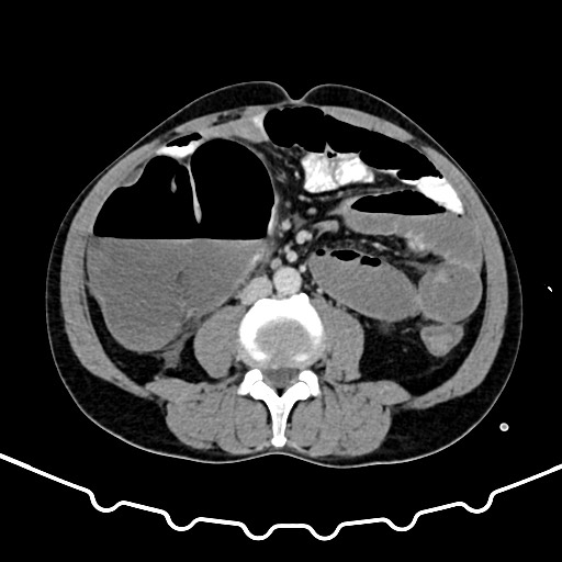 File:Colocolic intussusception due to large lipoma (Radiopaedia 68773-78482 A 101).jpg