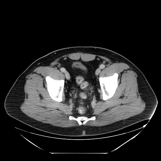 Colocolic intussusception due to lipoma (Radiopaedia 73712-84508 A 104).jpg